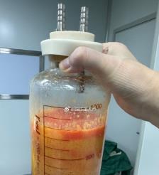 黔西南水动力吸脂手术要做多久？
